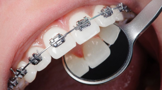 Orthodontic Brush for Braces - The Ultimate Guide to Proper Oral Care